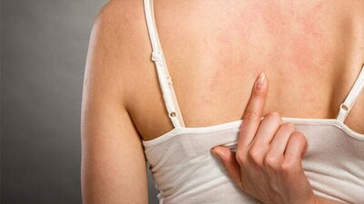 Kurdeşen belirtileri nelerdir?