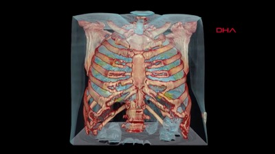 Koronavirüslü akciğerin görüntüsü paylaşıldı