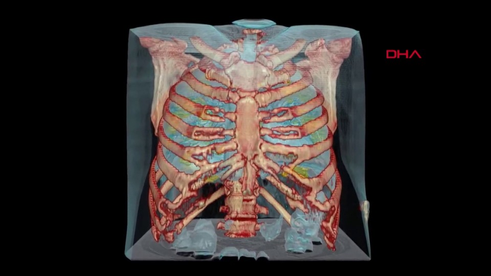 Koronavirüslü akciğerin görüntüsü paylaşıldı