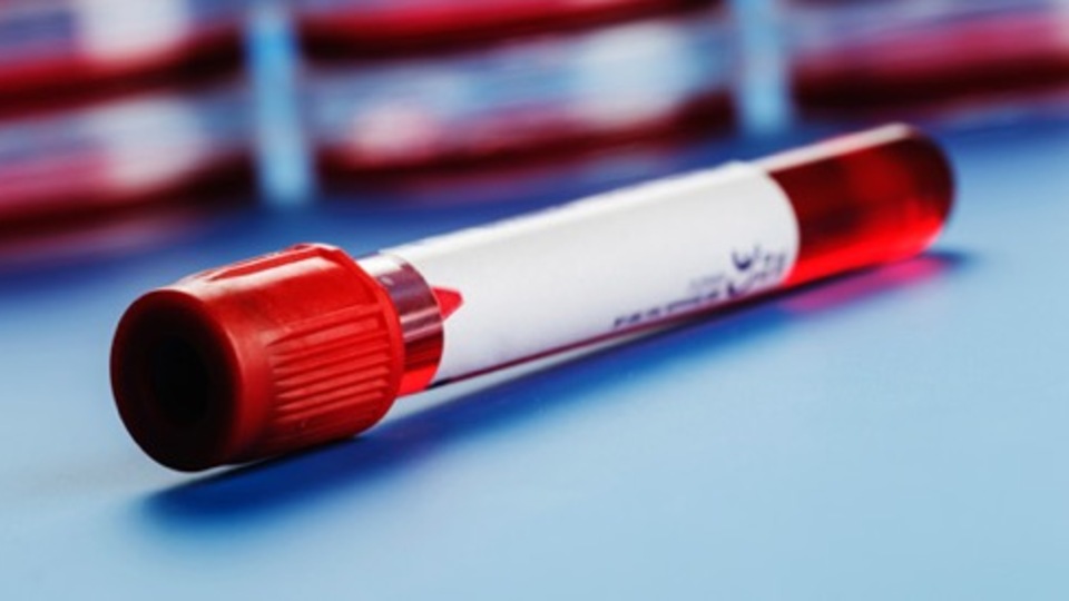 Hct (hematokrit) testi hakkında merak edilenler