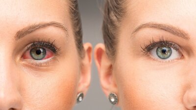 Göz yanması belirtileri ve tedavisi