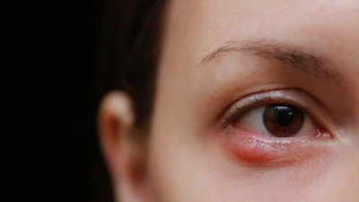 Şalazyon oluşumunun belirtileri ve nedenleri