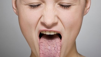 Sjögren sendromu belirtileri, türleri ve nedenleri