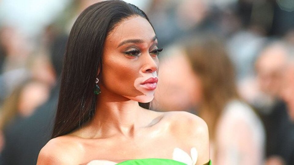 Vitiligo hastalığının nedenleri ve tedavi yöntemleri