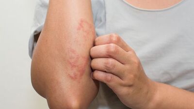 Sedef hastalığında tanı ve tedavi