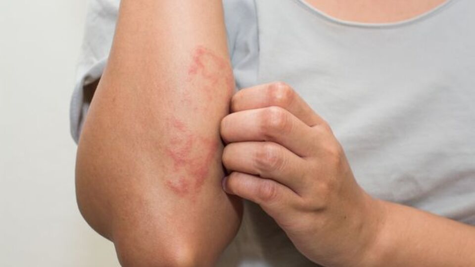 Sedef hastalığında tanı ve tedavi