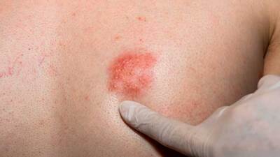 Zona hastalığının belirtileri ve tedavisi