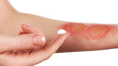 1. derece yanıklarda dikkat edilmesi gerekenler