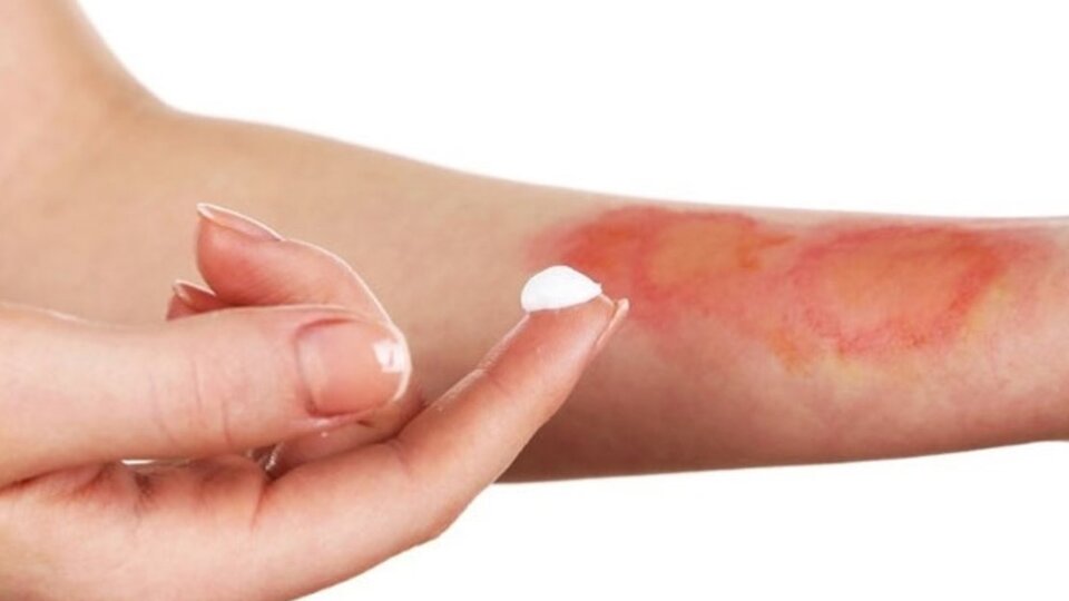 1. derece yanıklarda dikkat edilmesi gerekenler