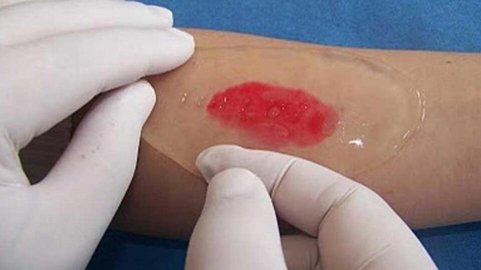 2. derece yanık belirtileri ve tedavisi