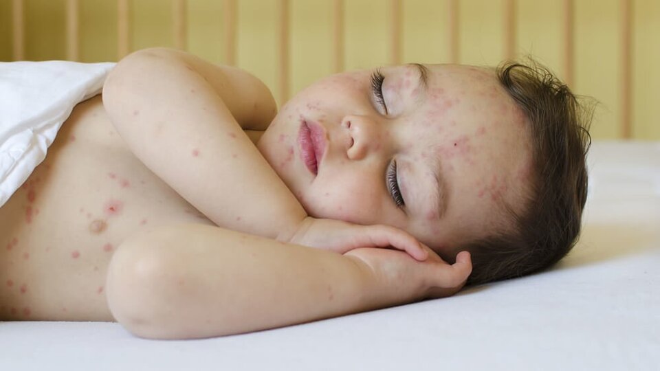 Bebeklerde altıncı hastalık belirtileri