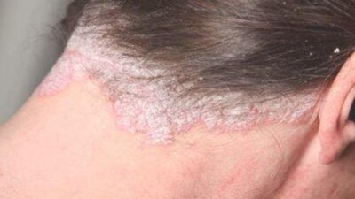 Seboreik dermatit nedir?