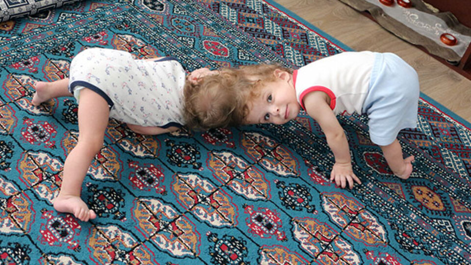 Antalyalı siyam ikizleri İngiltere'de ayrıldı