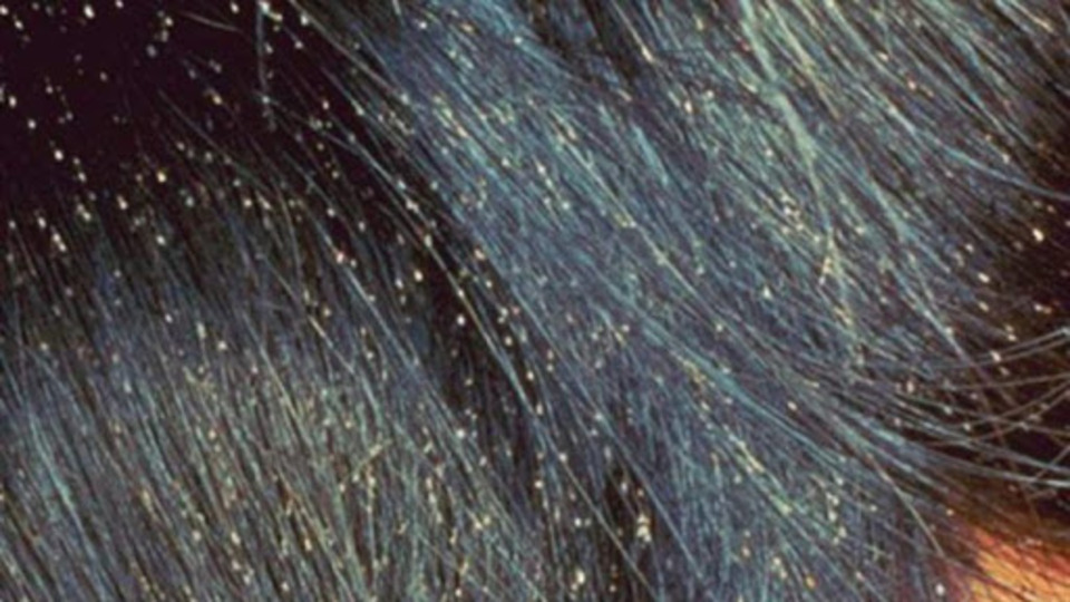 Bitten kurtulmanın yolları nelerdir?