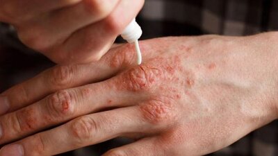 Egzama tedavisinde Aloe Vera etkisi