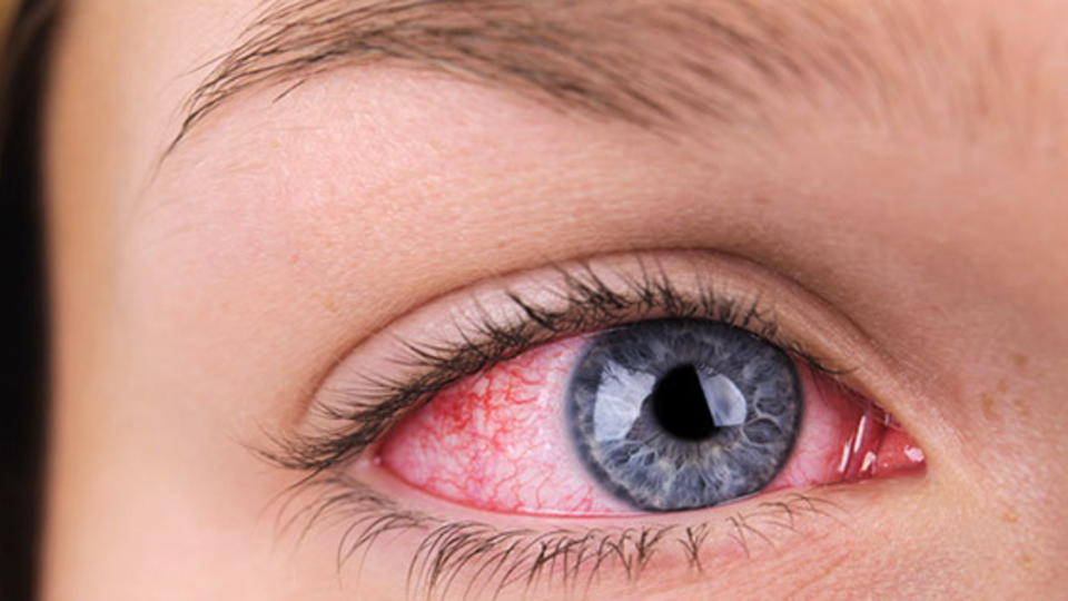 Göz kanlanması hastalık habercisi olabilir!