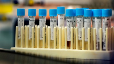 Koronavirüs salgınında yeni vaka sayısı 1172