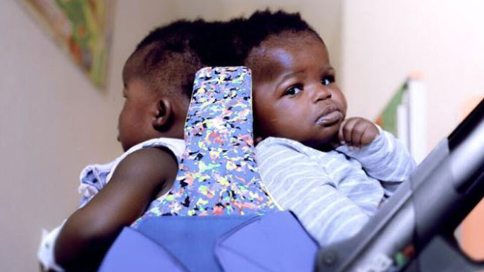 Afrikalı siyam ikizleri 18 saatlik operasyonla ayrıldı