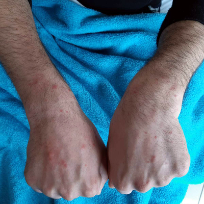 Cerrahpaşa'da koronavirüs hastalarının deri bulguları incelendi