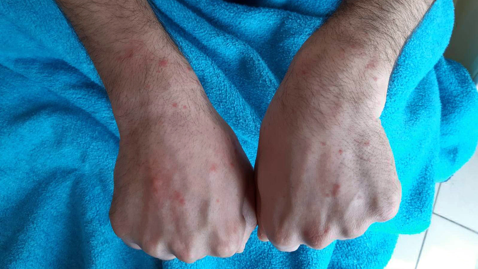 Cerrahpaşa'da koronavirüs hastalarının deri bulguları incelendi