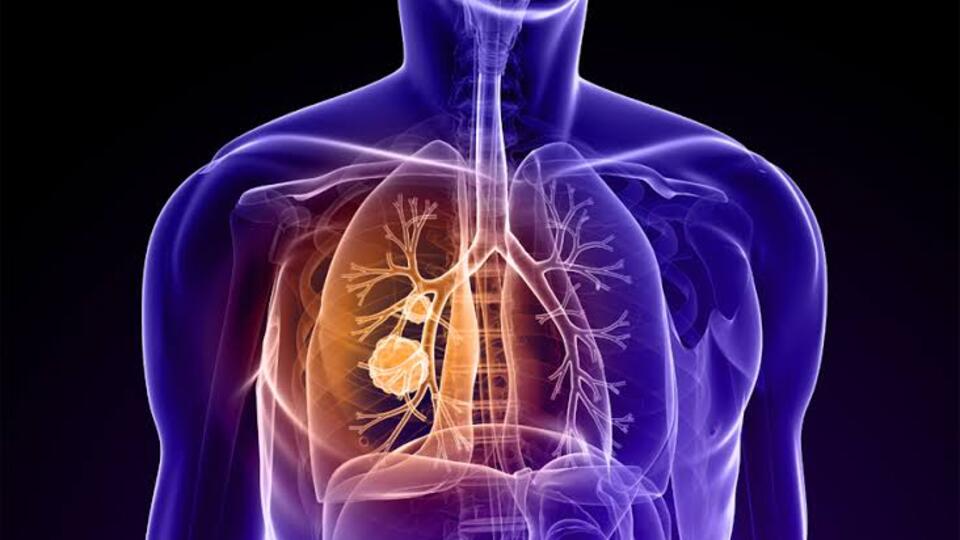 Pnömoni nedir, ne demek?