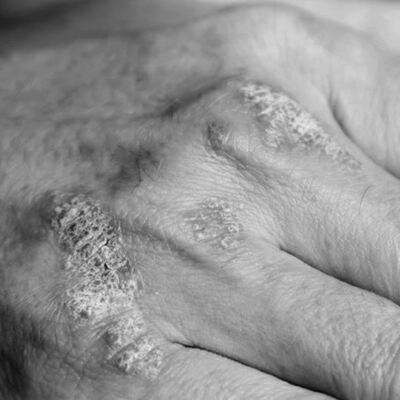 Alerji, ürtikerin sık sebepleri arasında değil