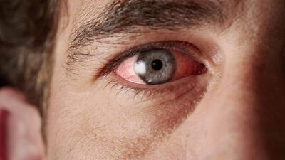 Göz ağrısına yol açan etkenler