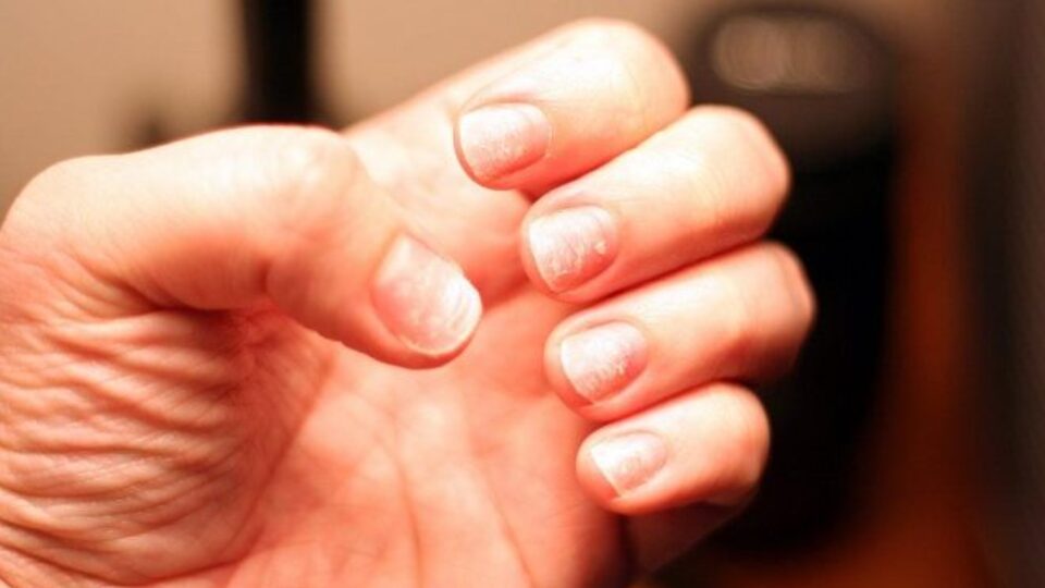 Tırnak soyulmasının nedenleri
