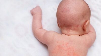 Bebek ve yetişkinlerde isilik tedavisi