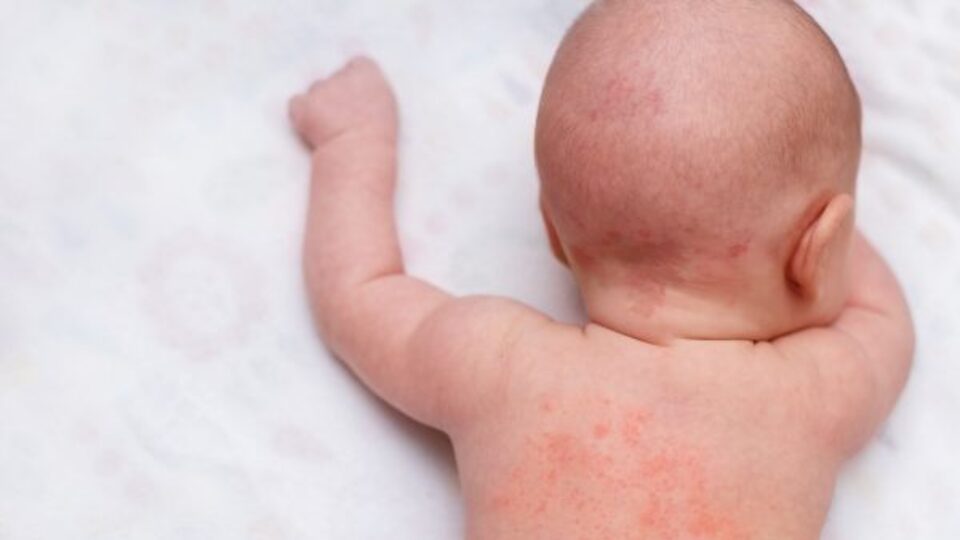 Bebek ve yetişkinlerde isilik tedavisi