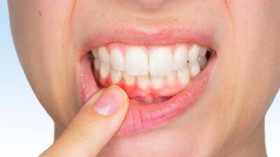 Diş eti kanamasına yol açan sebepler