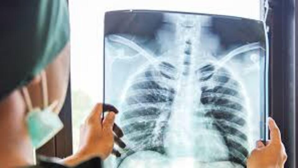 Pnömonili hasta ne demek?