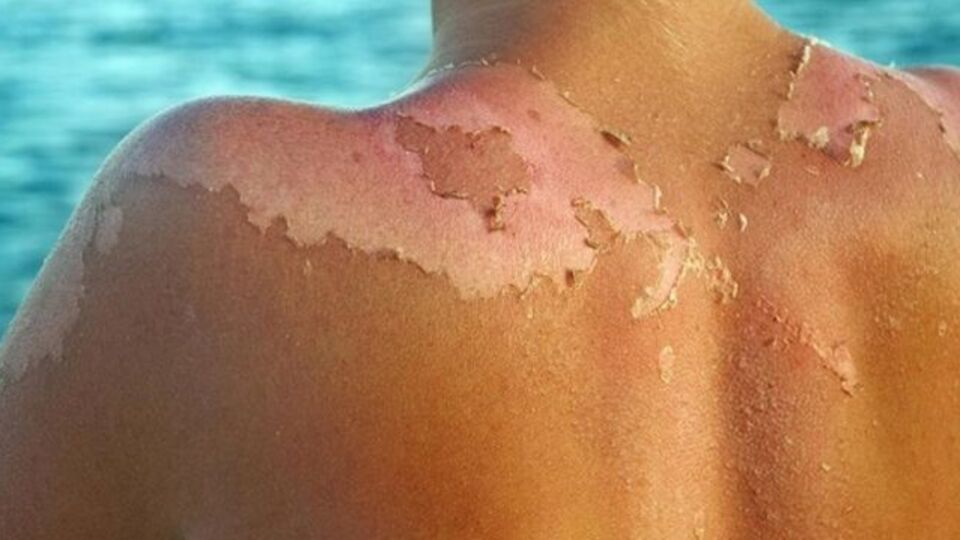 Güneş yanığına karşı tedavi yöntemleri
