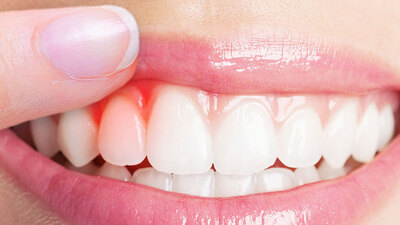 Diş eti kanamasına karşı öneriler