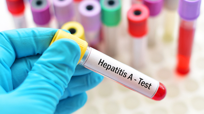 Hepatit A belirtileri ve tedavisi