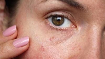 Kılcal damarlarda çatlak oluşumunun nedenleri