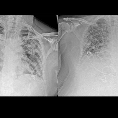 Koronavirüsün akciğerdeki ağır tahribatı görüntülendi