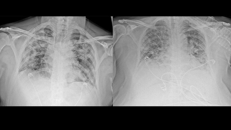 Koronavirüsün akciğerdeki ağır tahribatı görüntülendi