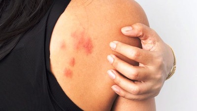 Kurdeşen hastalığı belirtileri ve tedavisi