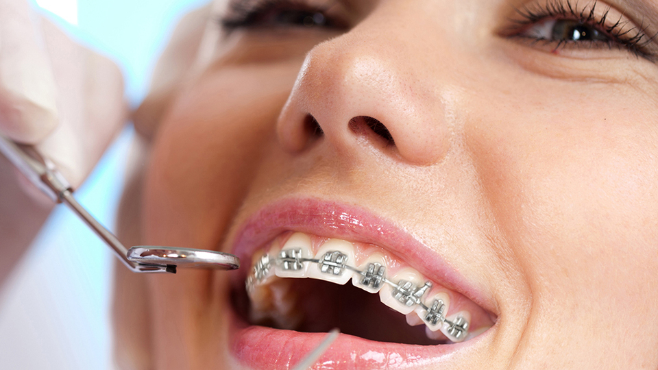 Diş teli tedavisi hakkında merak edilenler