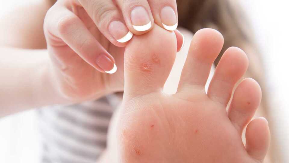 Nasır oluşumunun nedenleri ve tedavi yöntemleri