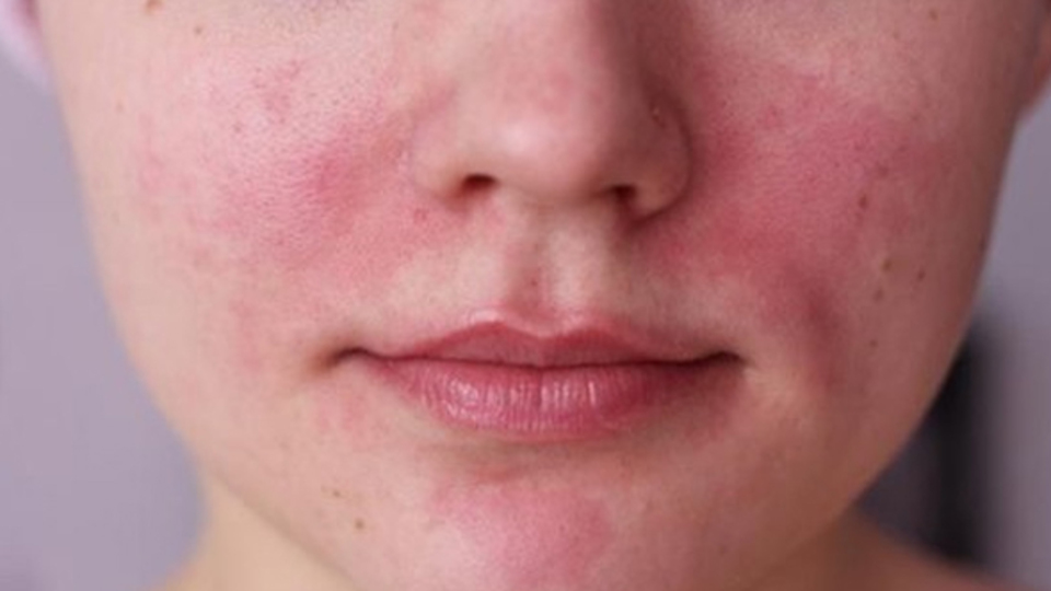 Cilt kuruluğuna iyi gelen uygulamalar