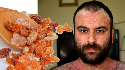 Arap Zamkı sedefe iyi gelir mi?