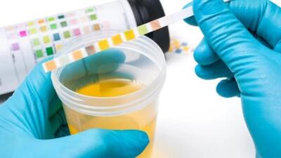 İdrar renklerine göre hastalık belirtileri