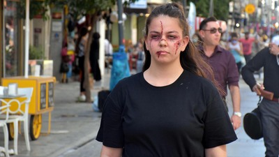 Kesik, morluk ve yara iziyle dışarı çıktı... İşte işin aslı