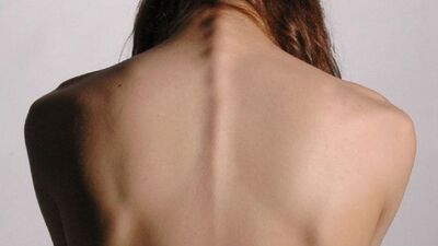 Omurga eğriliğine karşı tedavi yöntemleri