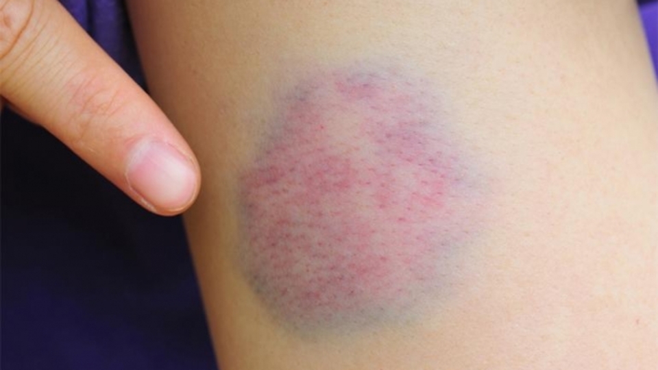 İç kanama nedenleri ve belirtileri