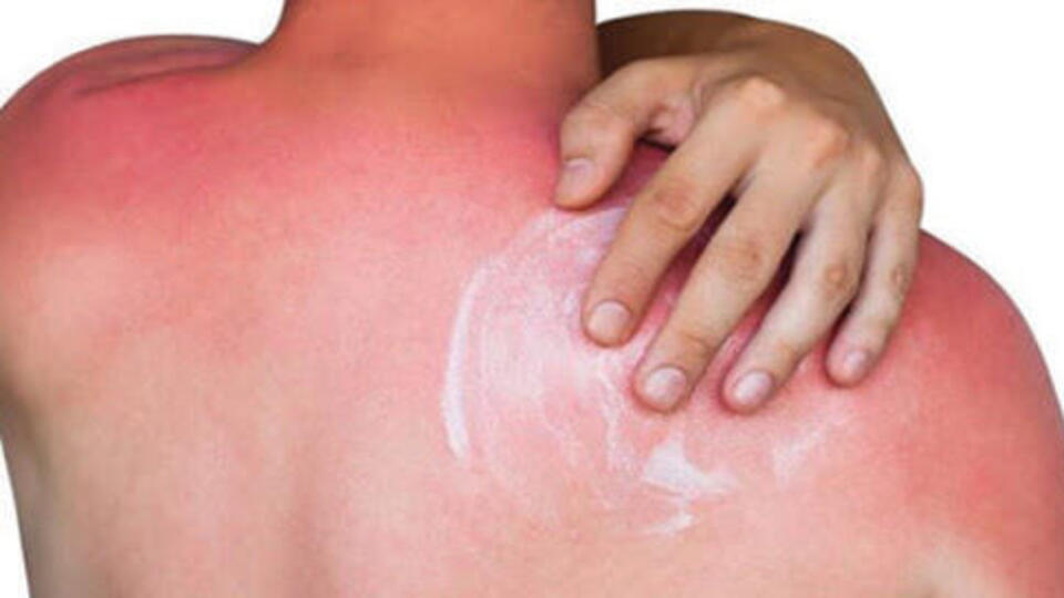 Güneş yanığına iyi gelen uygulamalar