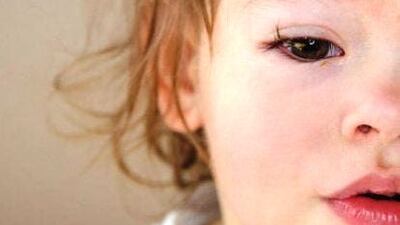 Göz nezlesinin nedenleri ve tedavi uygulamaları