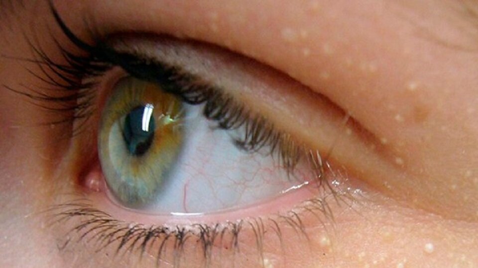 Yağ bezelerinin oluşma sebepleri